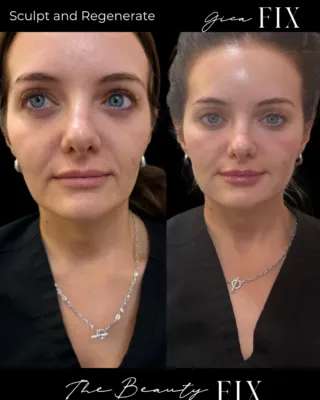 Before and after facial balancing treatment showing improved volume and contour in the lower face