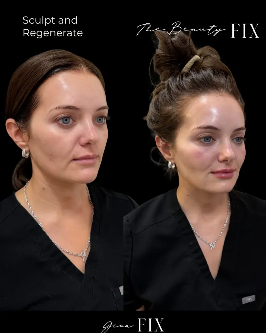 Renuva injectable treatment for facial volume loss supporting natural fat regeneration and long-term skin quality.