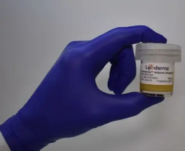 Gloved hand holding a small vial labeled Lipoderm adipose allograft with a white cap, against a neutral background.