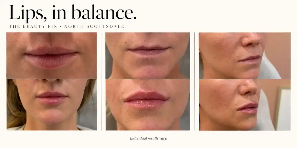 Lip filler comparisons from two patients at The Beauty Fix in North Scottsdale, showing front views of both and a side view of one.